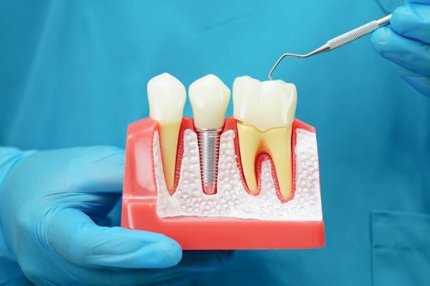 How Implant Dentists Build Confidence Through Lasting Restorations