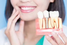 3 Signs You Should Consider Implants As Part Of Your Smile Makeover