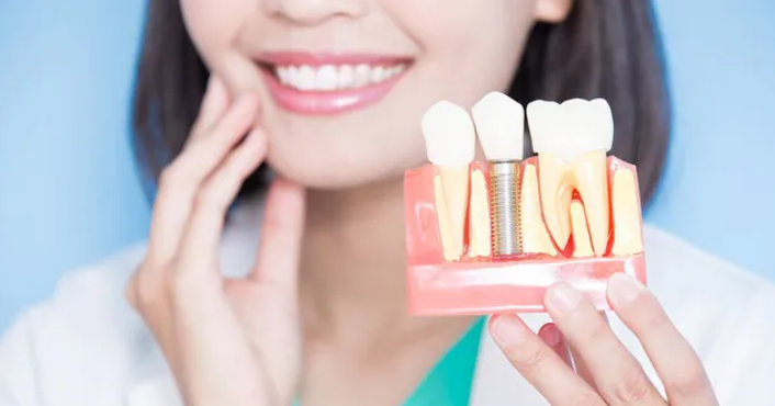 3 Signs You Should Consider Implants As Part Of Your Smile Makeover